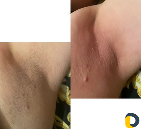 Шугаринг, восковая эпиляция, пленочный воск