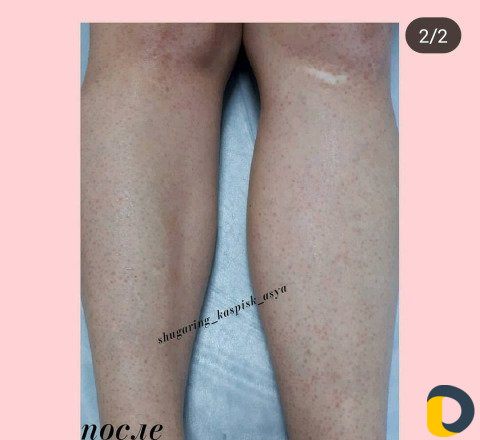 Шугаринг всего тела