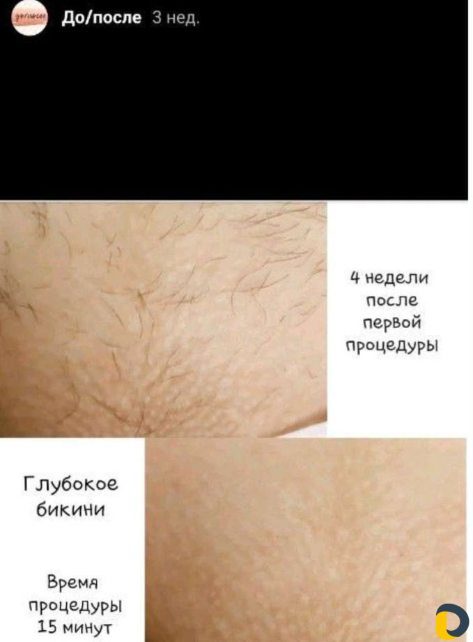 Шугаринг. Женская и мужская депиляция