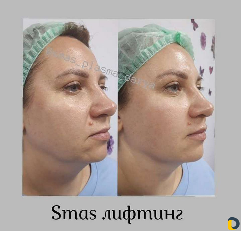 Smas лифтинг Лица