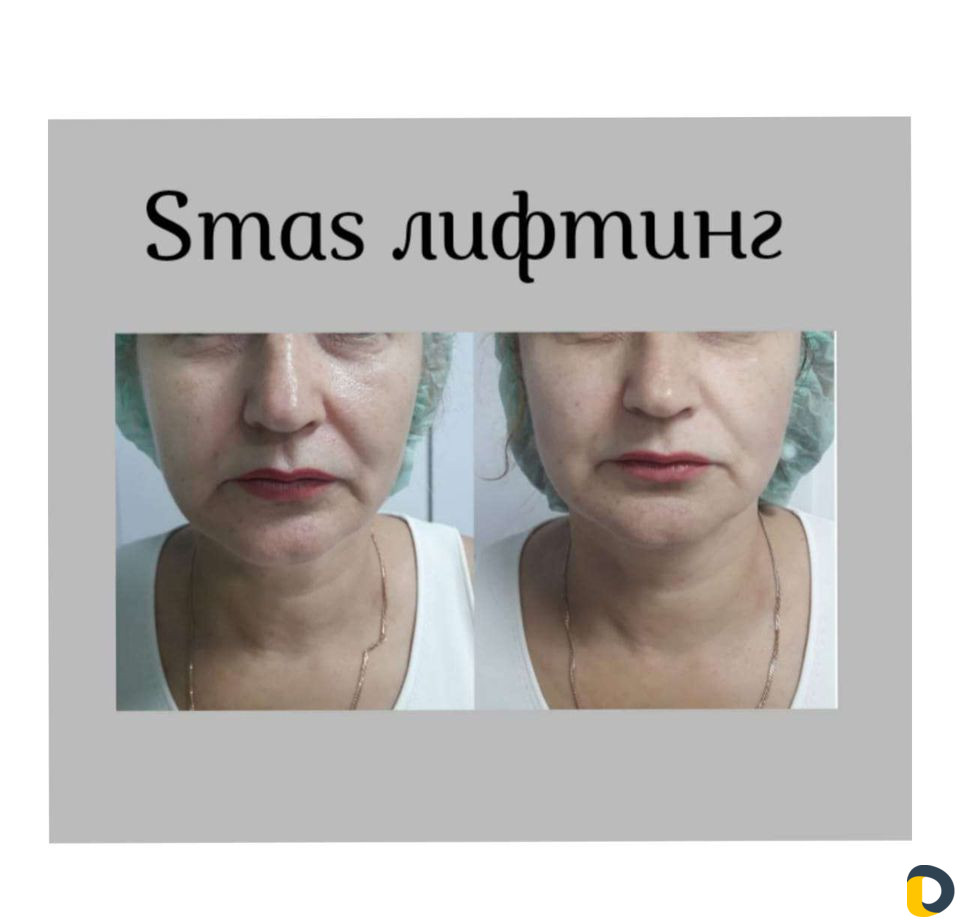 Smas лифтинг Лица