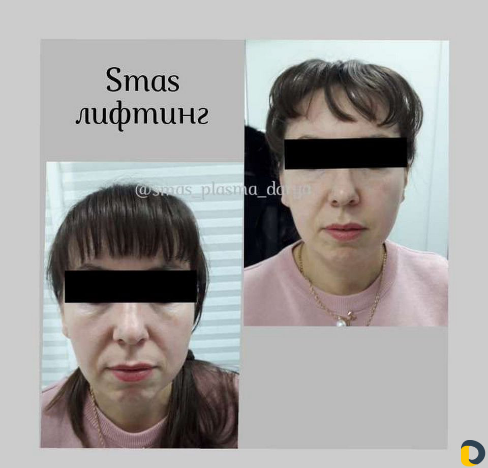 Smas лифтинг Лица