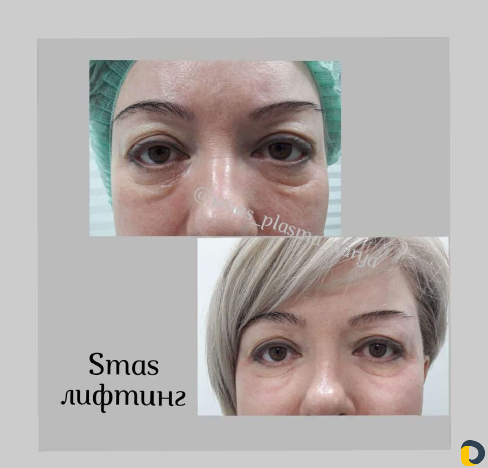 Smas лифтинг Лица