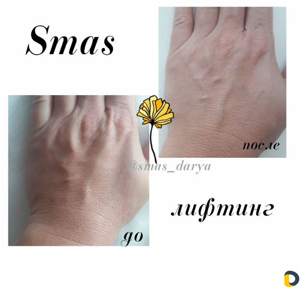Smas лифтинг Лица