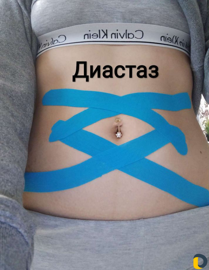 Тейпирование