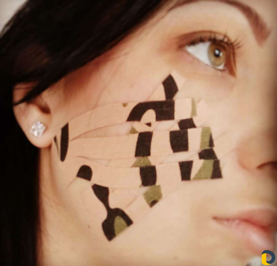 Тейпирование