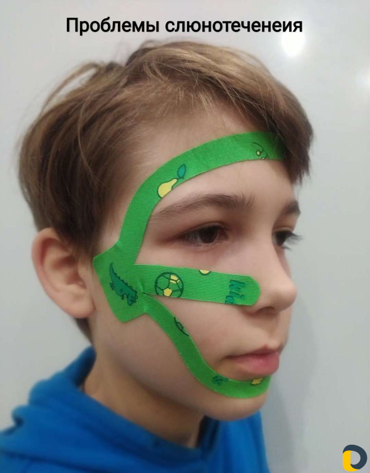 Тейпирование