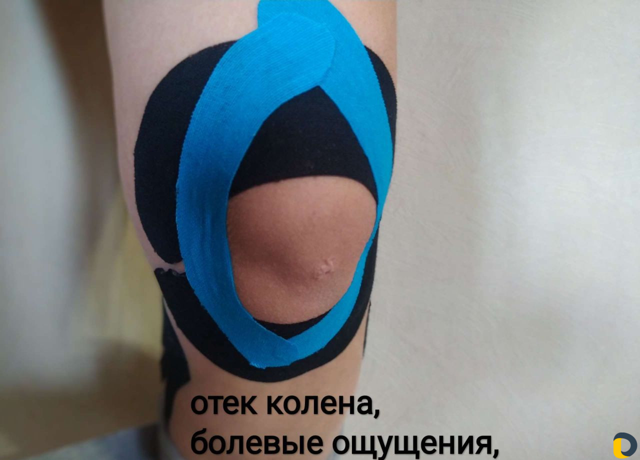 Тейпирование