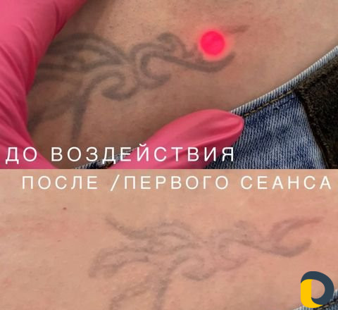 Удаление лазером