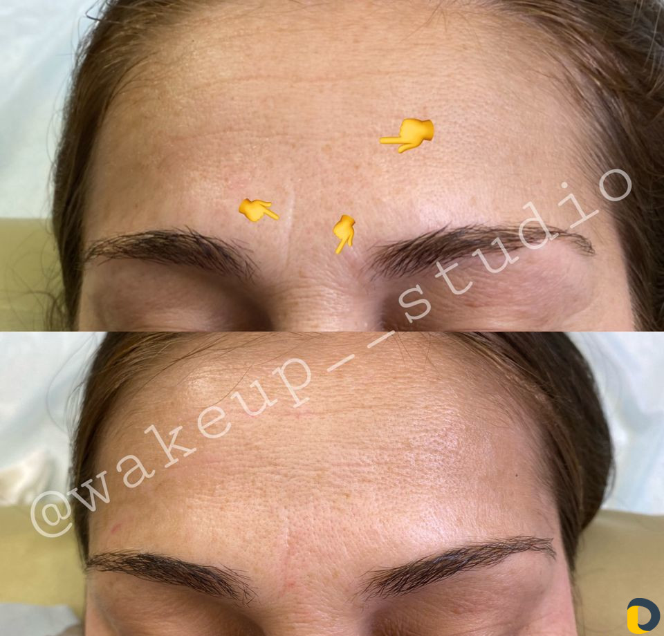 Удаление морщин