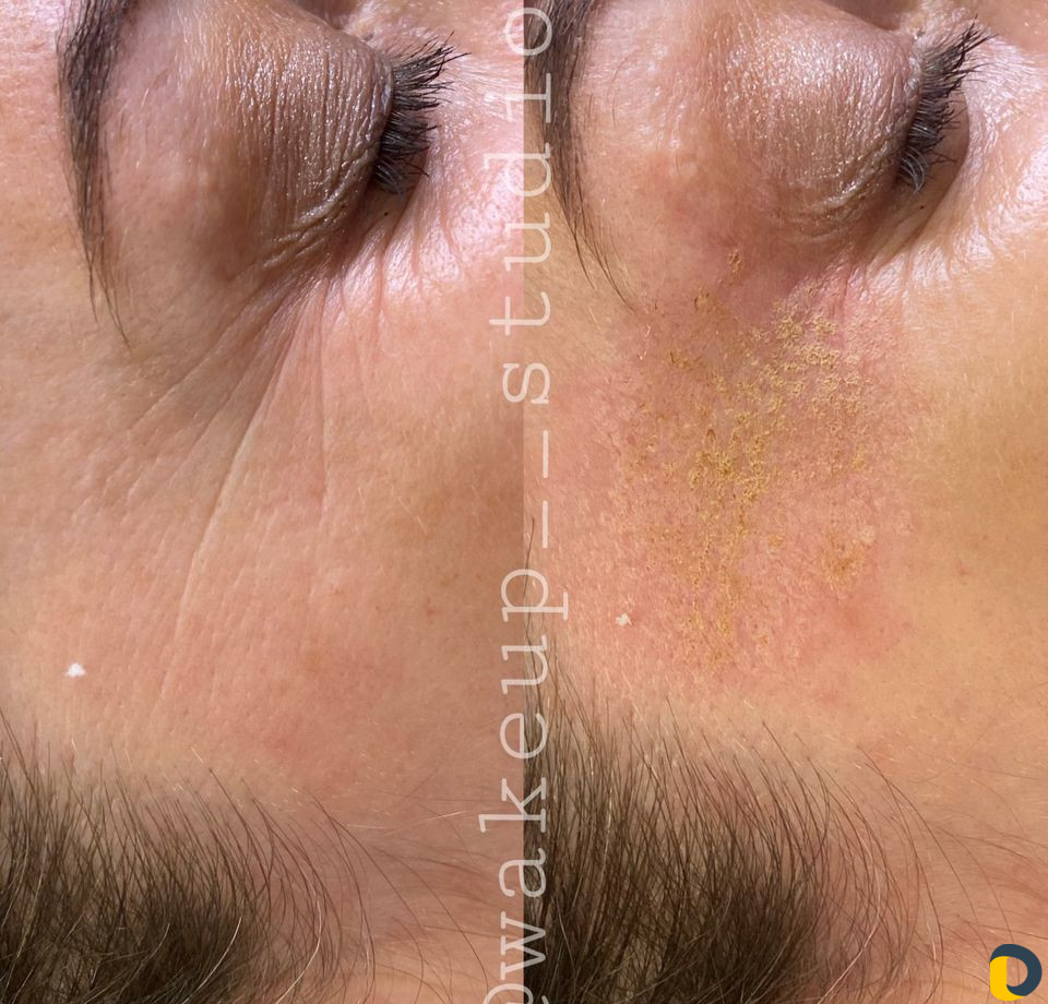 Удаление морщин