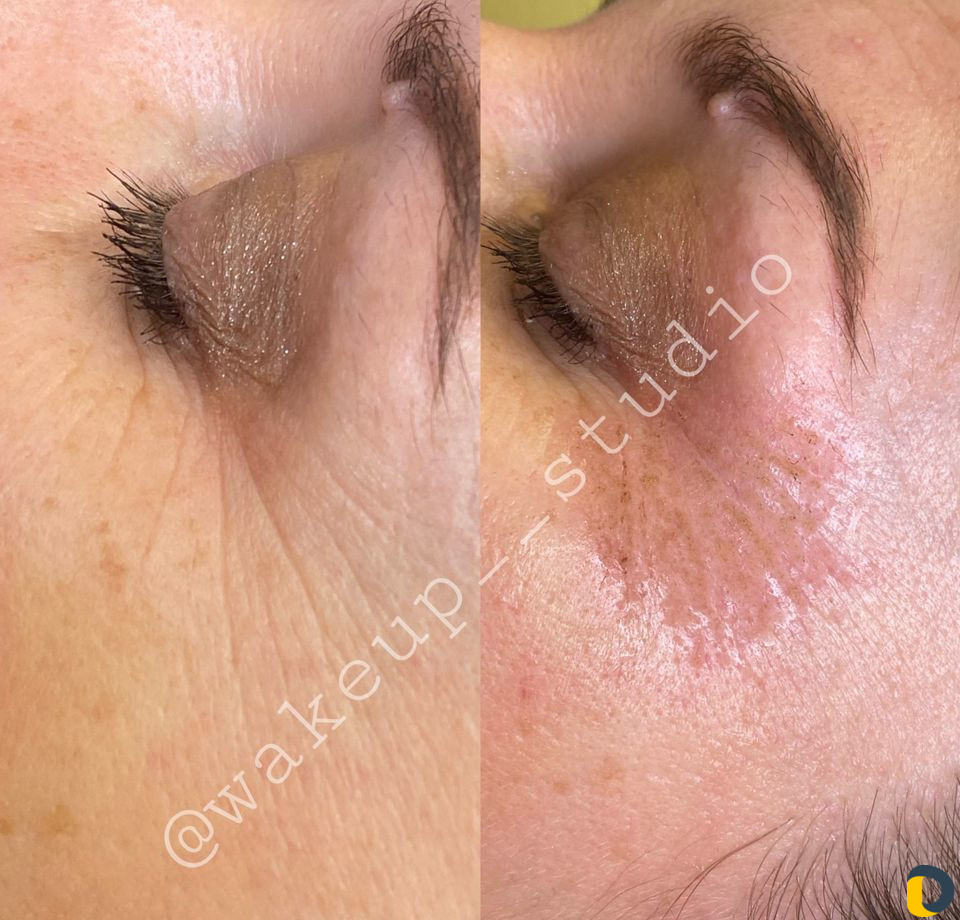 Удаление морщин