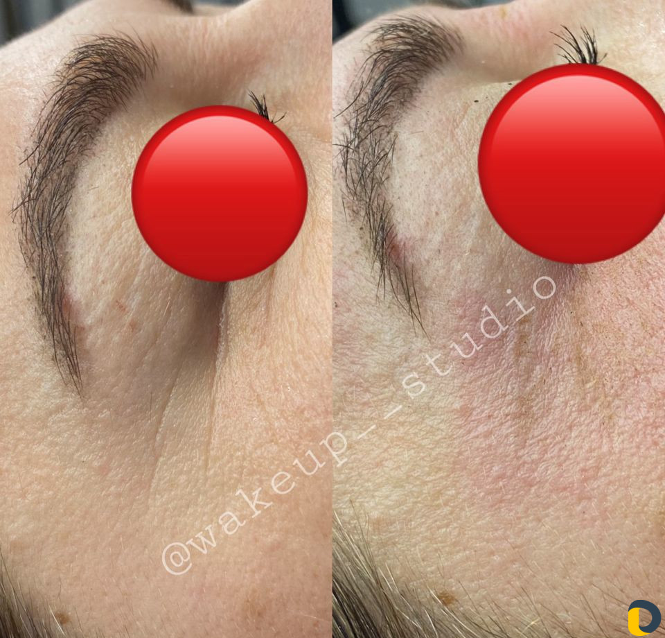 Удаление морщин