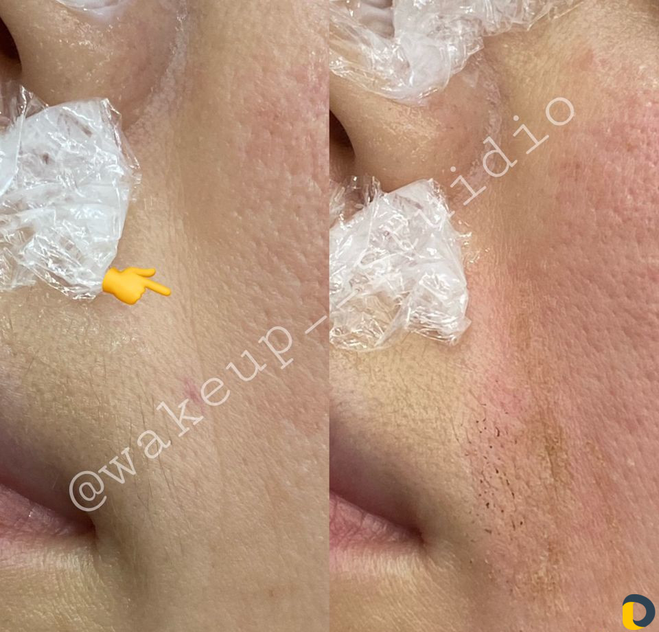 Удаление морщин