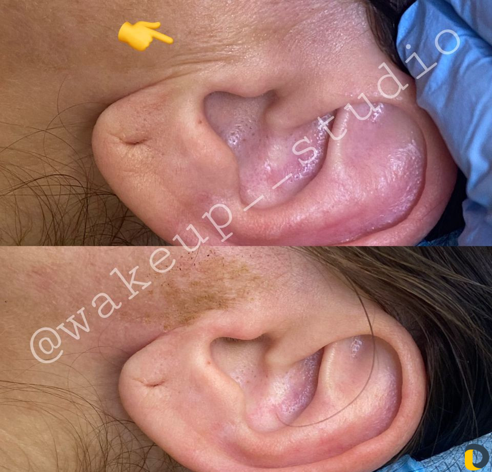 Удаление морщин