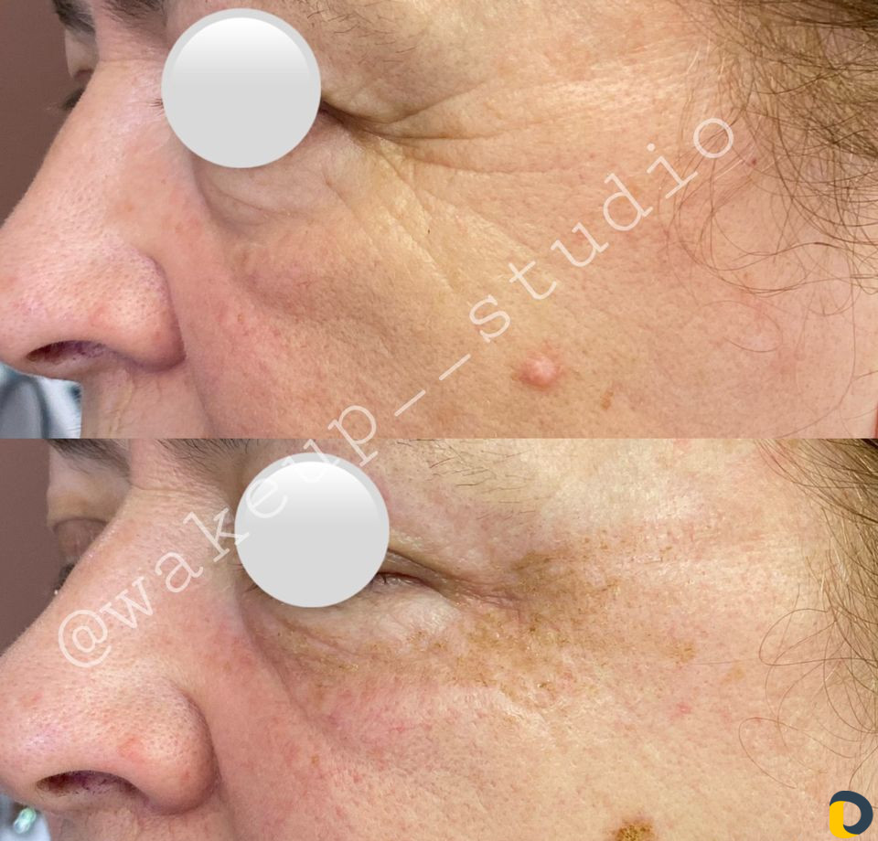 Удаление морщин