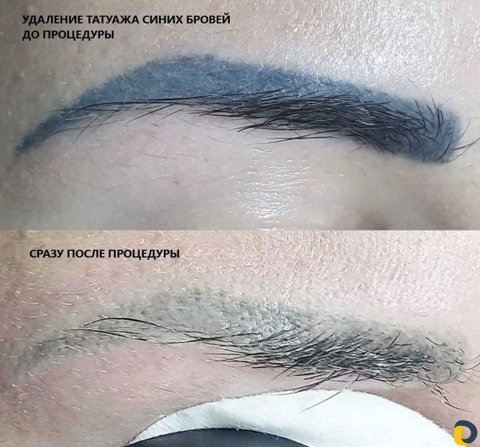 Удаление тату и перманентного макияжа