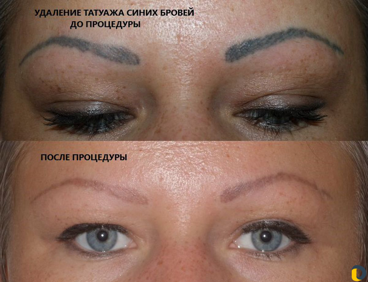 Удаление тату и перманентного макияжа