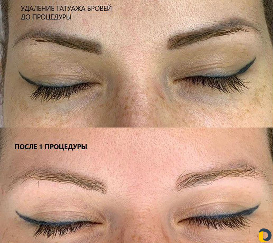 Удаление тату и перманентного макияжа