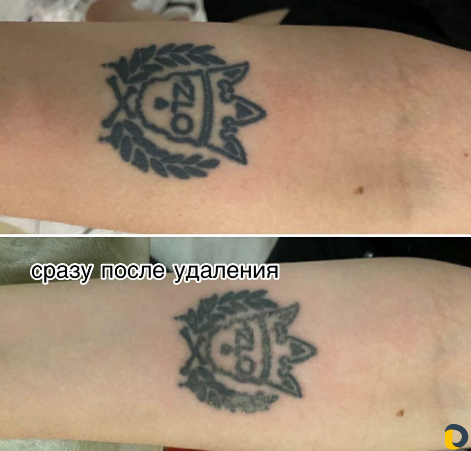 Удаление тату и татуажа