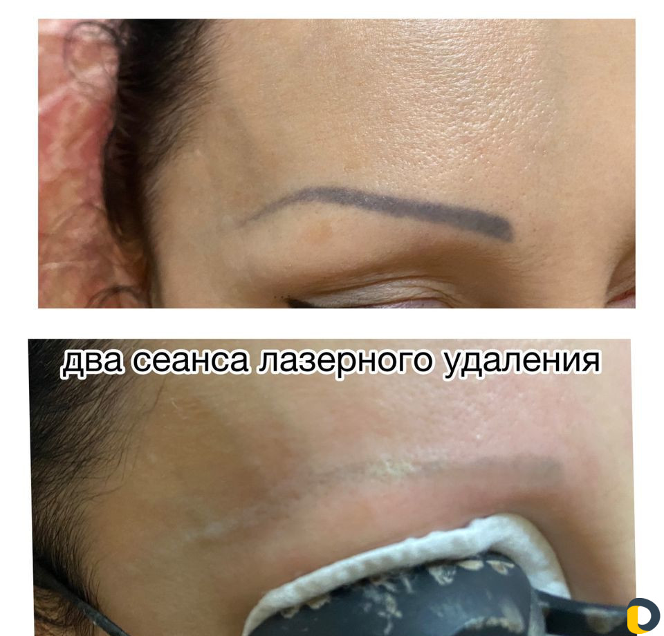 Удаление тату и татуажа