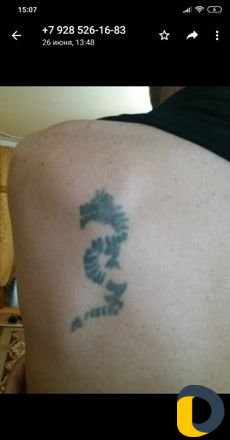 Удаление тату лазером без шрамов и рубцов