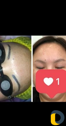 Удаление тату лазером без шрамов и рубцов