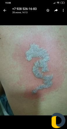 Удаление тату лазером без шрамов и рубцов