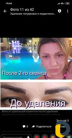 Удаление тату лазером без шрамов и рубцов