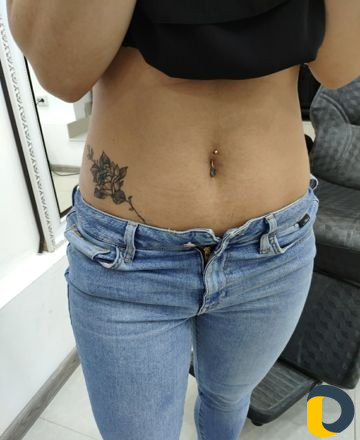 Удаление тату лазером без шрамов и рубцов