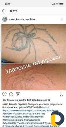 Удаление тату лазером