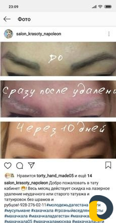 Удаление тату лазером
