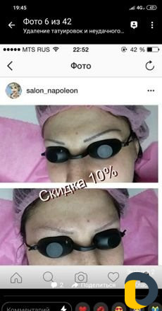 Удаление тату лазером