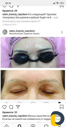 Удаление тату лазером