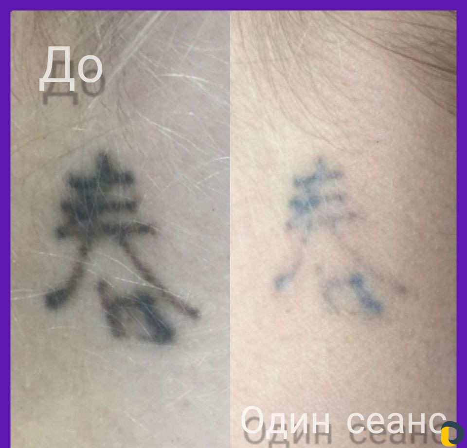 Удаление тату
