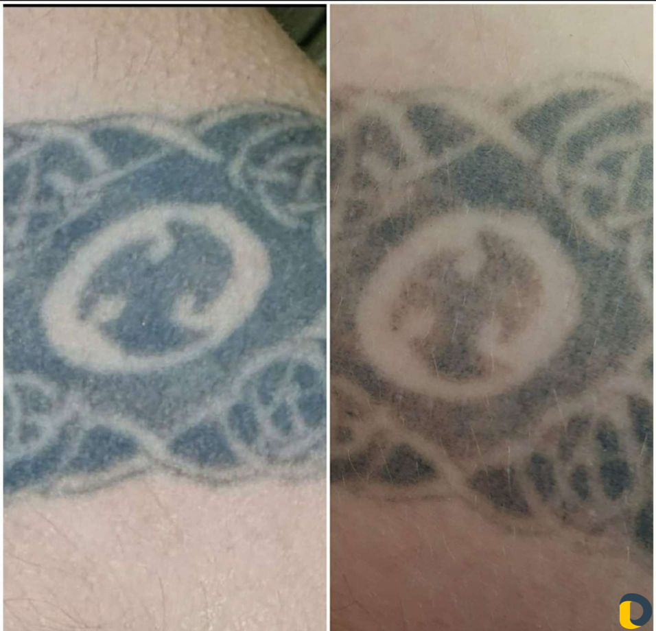 Удаление тату