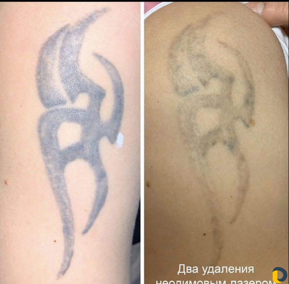 Удаление татуажа, тату