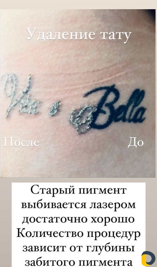 Удаление татуажа