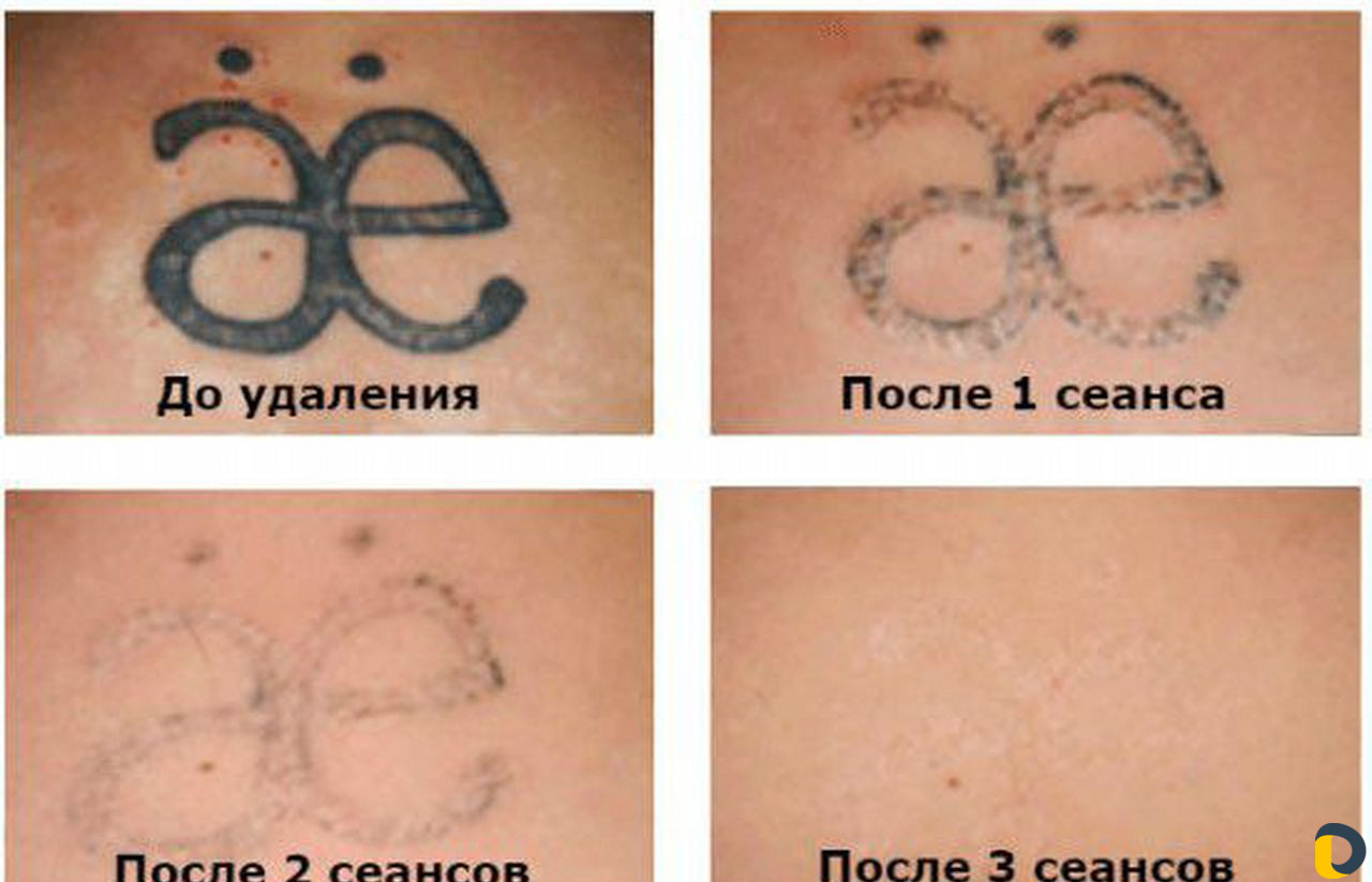 Удаление татуажа