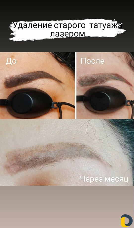 Удаление татуажа
