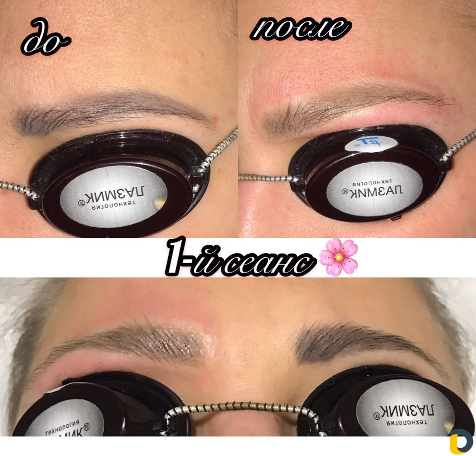 Удаление татуажа