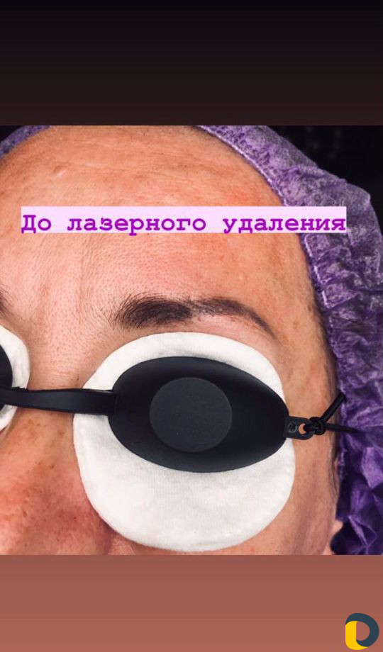 Удаление татуировок и перманентного макияжа