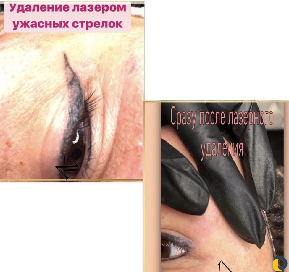Удаление татуировок и перманентного макияжа