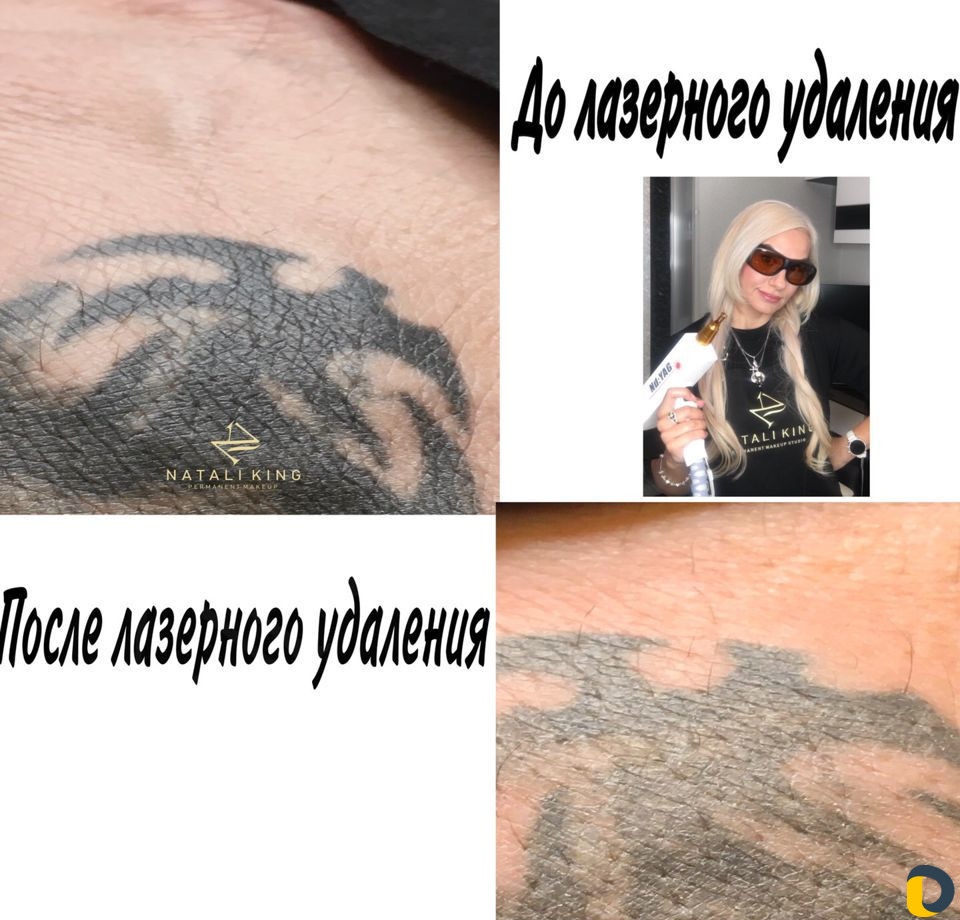 Удаление татуировок и перманентного макияжа