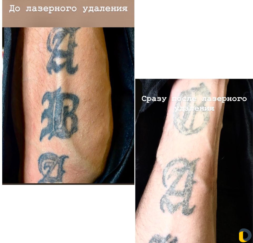 Удаление татуировок и перманентного макияжа