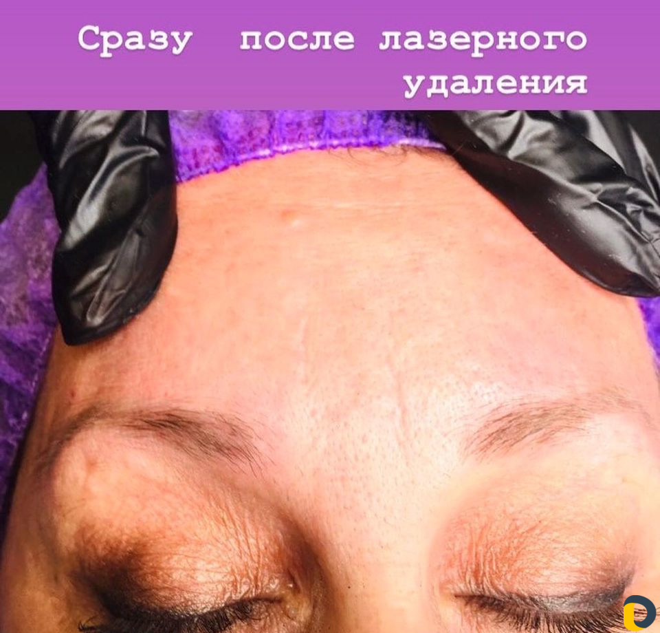 Удаление татуировок и перманентного макияжа