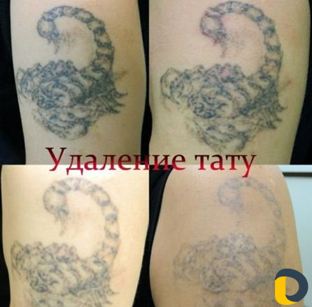 Удаление татужа,татуировок