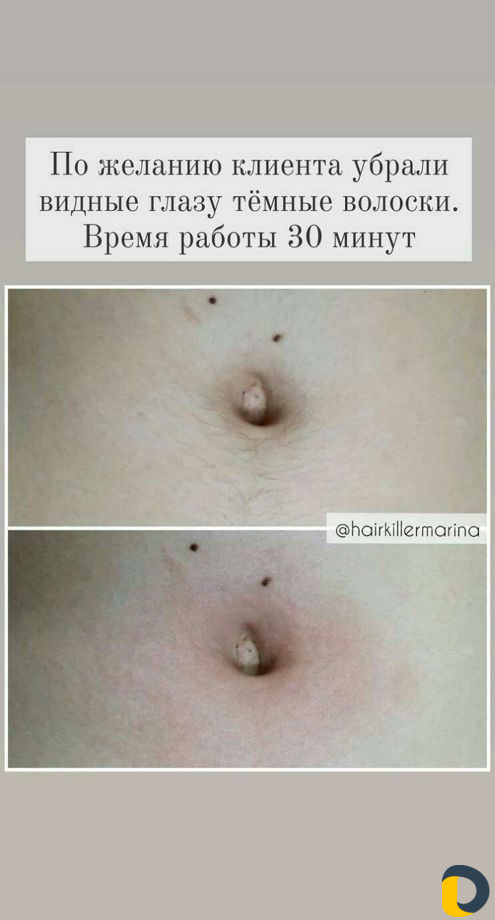 Удалю волосы навсегда (электроэпиляция)