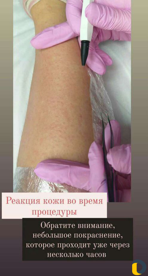Удалю волосы навсегда (электроэпиляция)