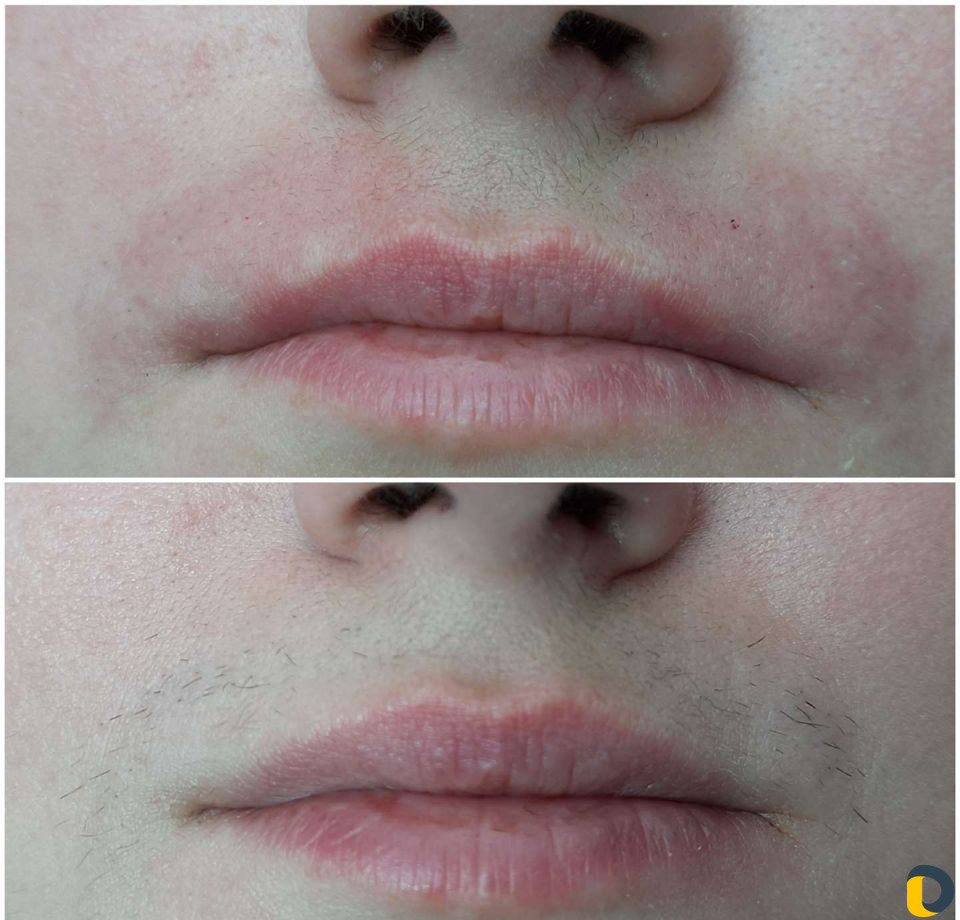 Удалю волосы навсегда (электроэпиляция)